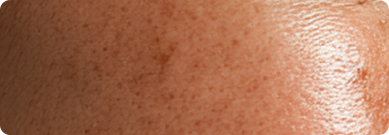 레이저 후 과색소침착