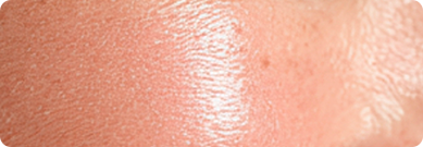 붉은기·홍반 지속