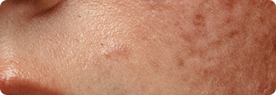 패임·흉터 발생