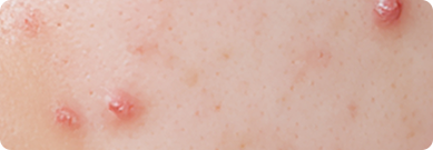 알레르기성 발진·가려움